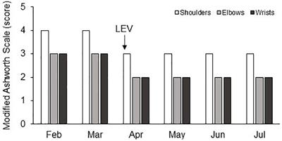 Levetiracetam Improves Upper Limb Spasticity in a Patient With Unresponsive Wakefulness Syndrome: A Case Report